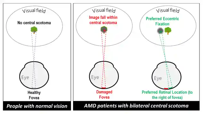 Eccentric Circles Eye Training: Visual Skills and Eye Health